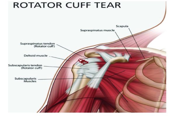 Difference Between Rotator Cuff Tear And Sub Acromial Impingement Syndrome Images And Photos