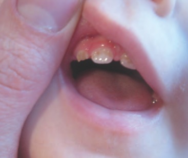 simptom tumbuh gigi