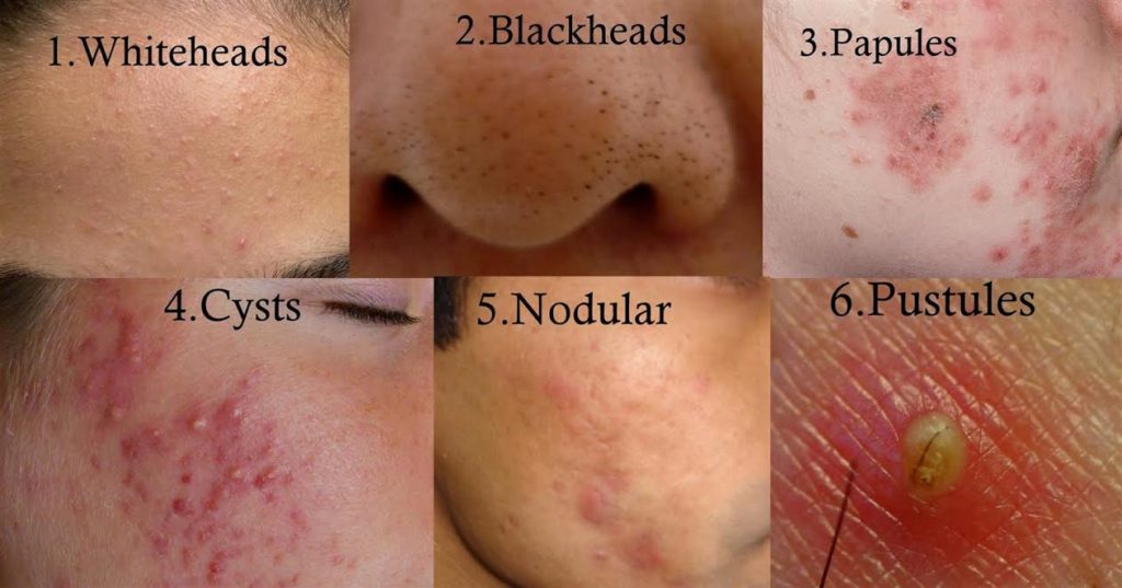 Hiruscar post acne